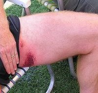 chafing on the thighs